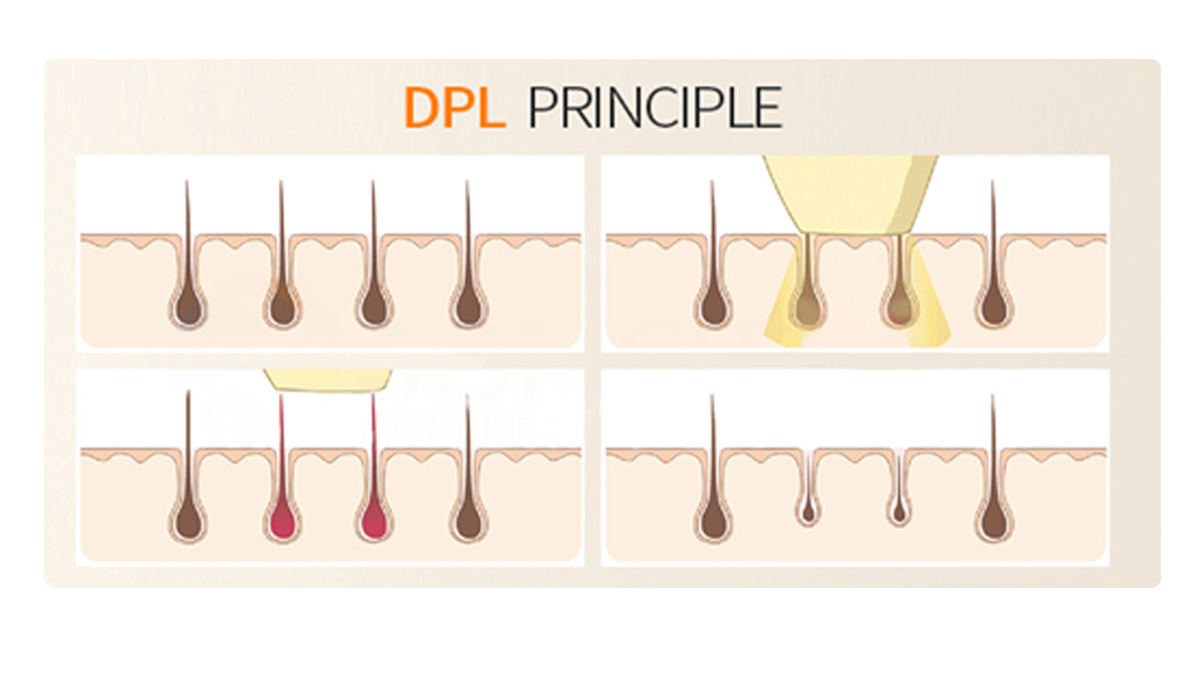 Attrezzatura per salone di bellezza DPL per la depilazione