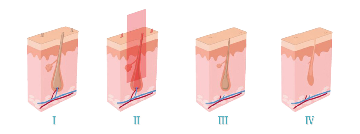 apparecchiature di bellezza ipl