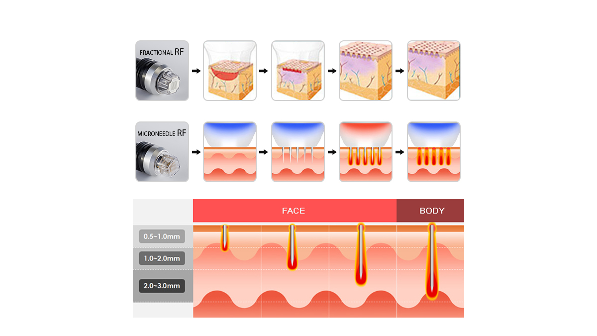 Macchina RF frazionata Microneedle