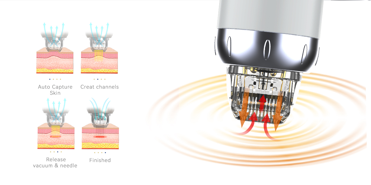 macchina rf microneedling sottovuoto